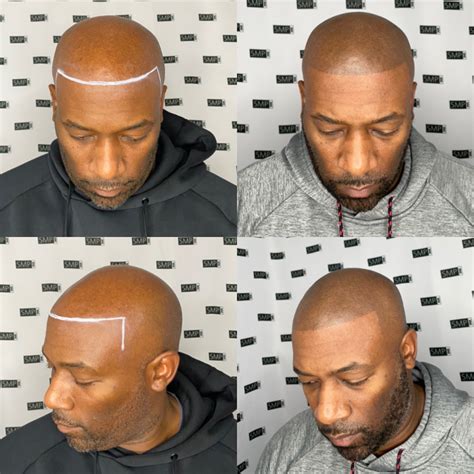 scalp micropigmentation albuquerque|MINK .